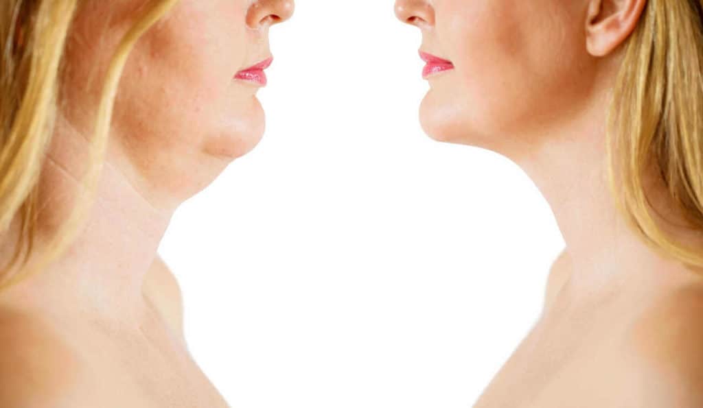 Double Chin treatment Scunthorpe before and after results