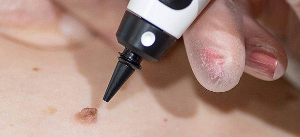 After Skin Tag Removal Scunthorpe