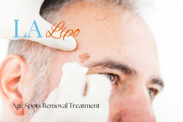 What Are the Most Effective Treatments for Age Spots Scunthorpe?
