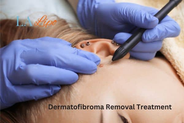 Dermatofibroma Removal Treatment Scunthorpe