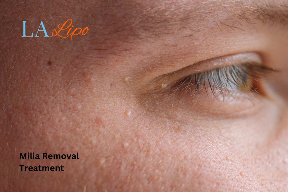 Cryopen Milia Removal: Is It the Easiest and Safest Option Scunthorpe?