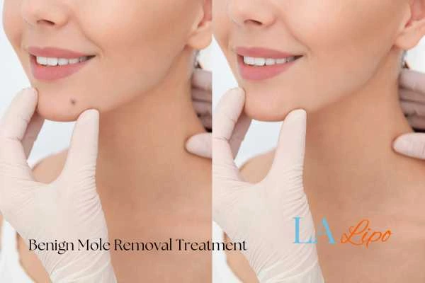 woman's before and after mole removal Scunthorpe results