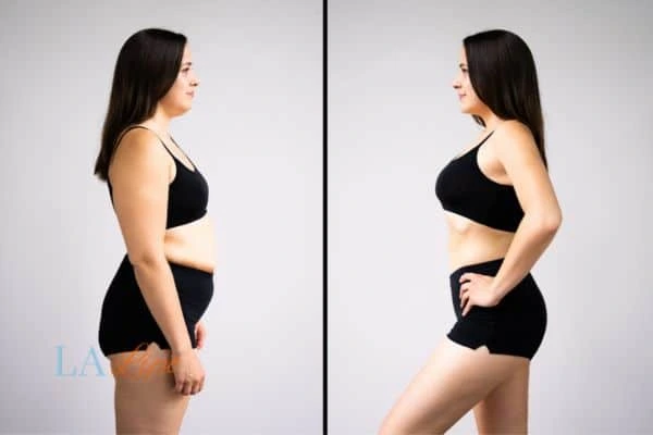 image of woman before and after results of LA-EMS Body Sculpting Scunthorpe to help treat Diastasis recti