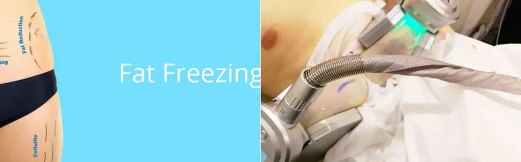 Fat freezing Scunthorpe on multiple areas of the body