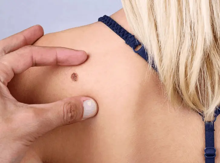 woman having mole removal Scunthorpe consultation before treatment.