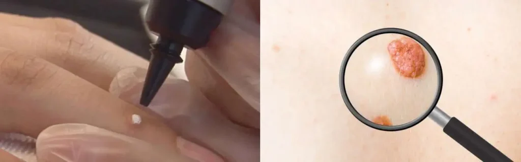 Cryopen for mole removal Scunthorpe - speak to our team today!