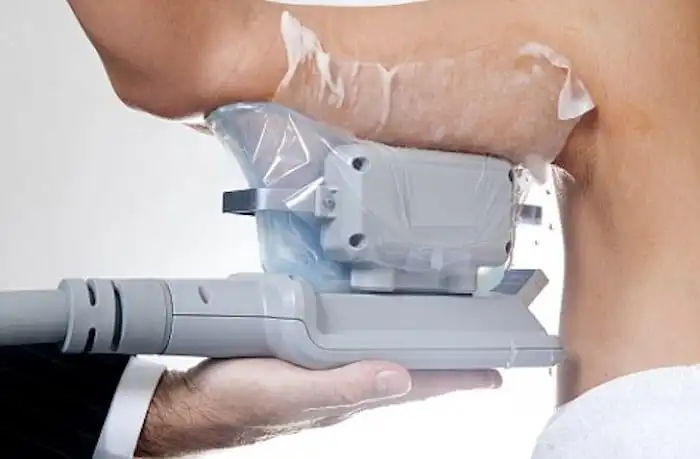 Picture of fat freezing Scunthorpe on the upper arms.