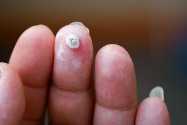wart on person finger - cryotherapy to treat from LA LIPO Scunthorpe