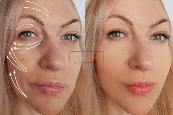 Morpheus 8 results Scunthorpe face lift.