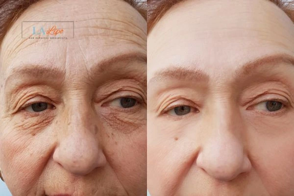 The powerful benefits of Morpheus8 Treatment Scunthorpe - Call Our team today!