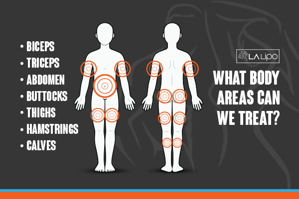 Diagram to show areas you can have LA-EMS Body Sculpting Treatment Scunthorpe