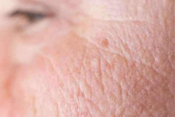 close up picture of a woman's face showing an age spot Scunthorpe