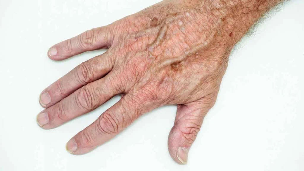 Male hand showing age spot Scunthorpe