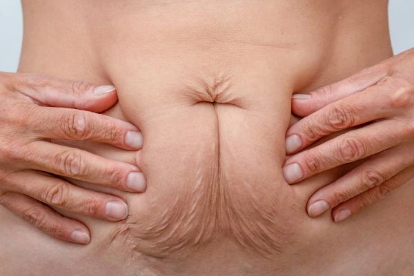 Should I Combine Diastasis Recti Treatment with Body Contouring for Better Results Scunthorpe?