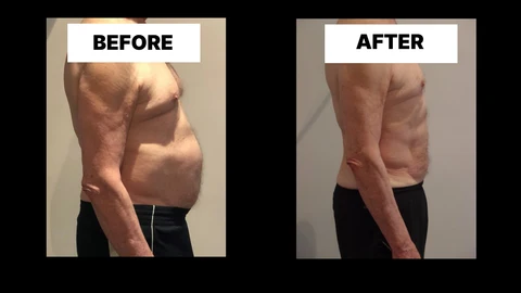 What Symptoms Can Diastasis Recti Cause in Men? Weak Core, Back Pain and Poor Posture Scunthorpe